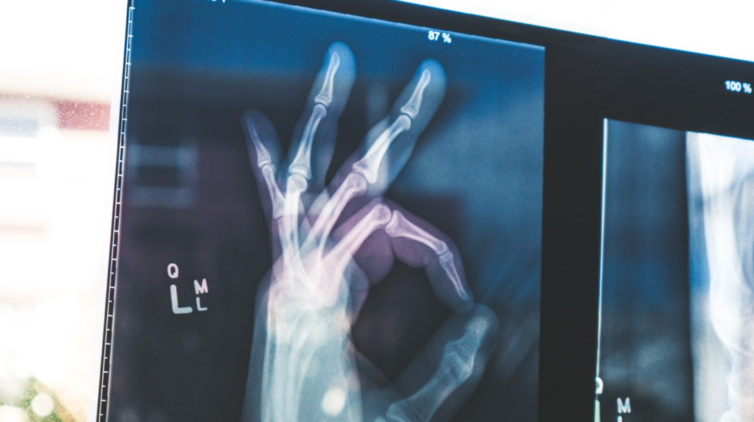 x-ray of human hand