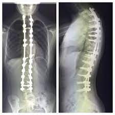 scoliosis xray