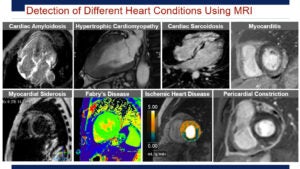 Detection of different heart conditions using MRI.