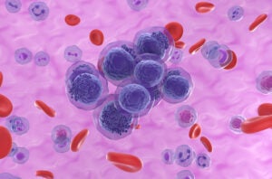 An illustration of acute myeloid leukemia